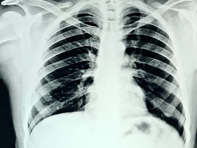 सामुदायिक स्वास्थ्य केंद्र दुद्धी अधीक्षक के पहल पर डिजिटल एक्सरे हुआ शुरू।