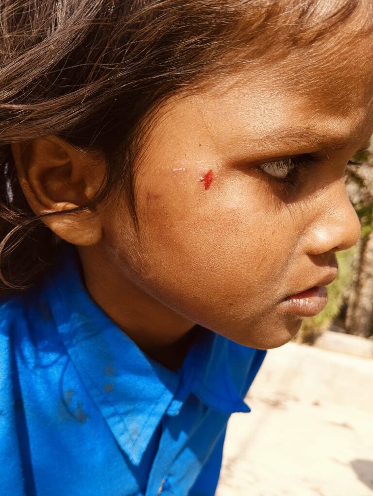 Sonbhadra News: बंदर के आतंक से सहमे लोग, बालिका समेत आधा दर्जन लोगों पर हमला