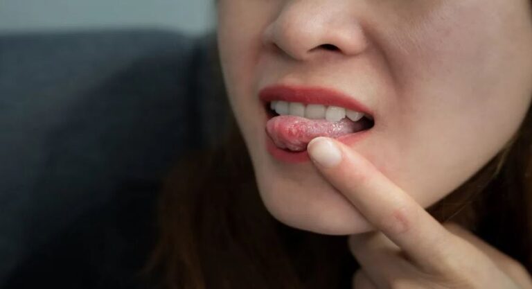 Health News : बार-बार मुंह में छाले होना गंभीर बीमारी का संकेत, जानिए कारण, संभावित रोग और बचाव के उपाय