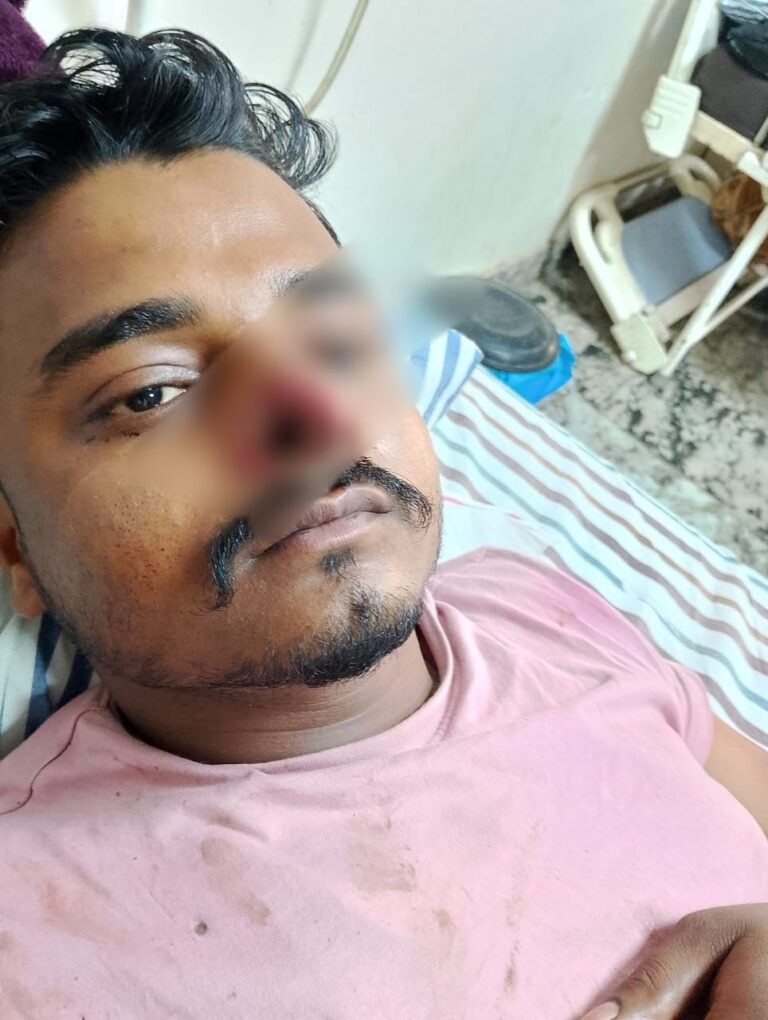 Sonbhadra News: शराब के नसे मे धूत युवक ने दूसरे युवक की दांतो से काटी नाक , युवक गंभीर वाराणसी रेफर।